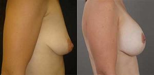 Breast lift before and after, image 03, Dr Doyle
