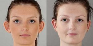 Otoplasty before and after, young female patient, image 09