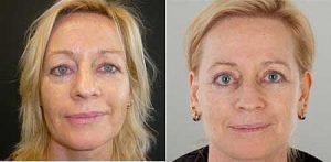 Facelift before and after image 03, Dr Doyle
