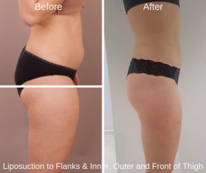 Lipoplasty gallery, before and after, image 03, Gold Coast Plastic Surgery