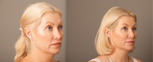 A female patient before and after rhinoplasty surgery with Dr Doyle, image 03