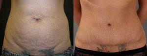 Patient before and after tummy tuck surgery, image 03, front view