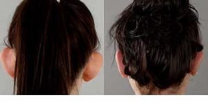 Adult female otoplasty patient before and after surgery, image 07, back view