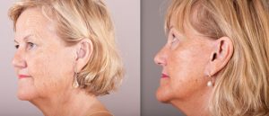 Female patient before and after face lift procedure, image 04