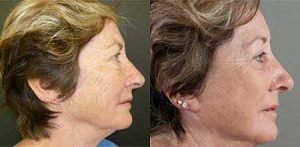 Facelift before and after, side view, image 04
