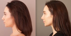 Liposuction gallery, before and after image 04, side view