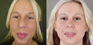 Rhinoplasty before and afters, image 12, front view, adult female patient