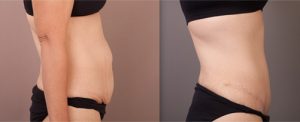 Patient before and after tummy tuck, image 04