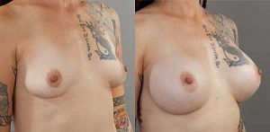 Breast augmentation 05, Gold Coast Plastic Surgery