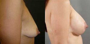 Patient before and after breast lift surgery, image 05
