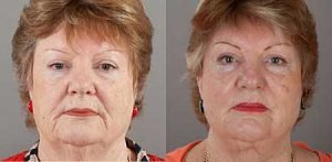 Facelift image gallery, patient before & afters, front view, image 05