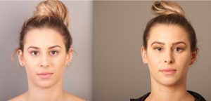 Rhinoplasty surgery before and after, female patient, front view, image 05