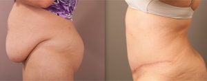 Tummy Tuck before & after image 05, Dr Doyle Gold Coast