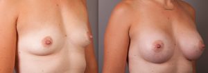 Breast augmentation gallery, before & after, photo 06