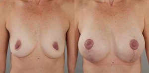 Breast lift gallery, before and after image 06