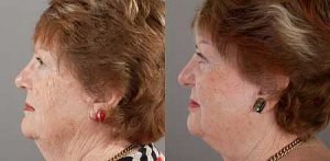 A female patient before and after face lift with Dr Doyle, image 06