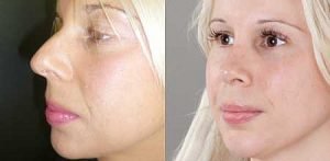 Rhinoplasty gallery, image 14, side view, female patient before and after surgery