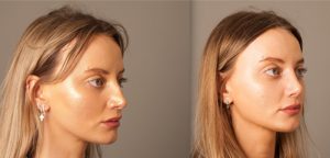 Rhinoplasty before and after, angle view, image 07