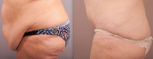 Abdominoplasty surgery before and after, image 06, Dr Doyle Gold Coast