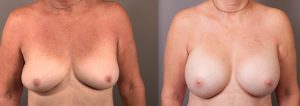 Patient before and after breast augmentation, image 07, Gold Coast Plastic Surgery