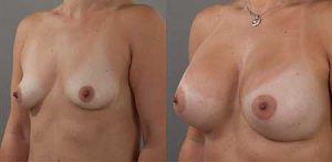 Breast implants surgery, image 07, angle view