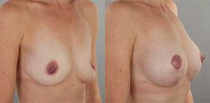 Mastopexy surgery before and after, image 07, angle view