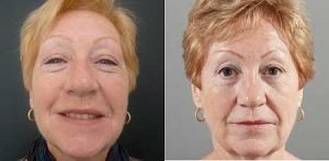 Facelift Surgery before and after