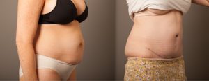 Tummy tuck before and after, image 07, side view