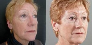Facelift Surgery before and after