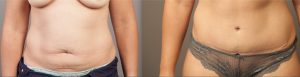 Tummy Tuck before and after gallery, image 08