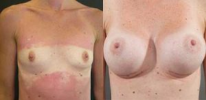 Breast Augmentation with implants, before and after, image 09