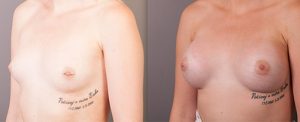 Patient before and after breast augmentation with Dr Doyle, image 01