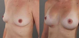 Breast Augmentation patient, before & after gallery, Dr Doyle