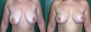 breast reduction surgery before and after - gallery image with real patient
