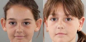 Otoplasty in children, before & after gallery, image 10, front view