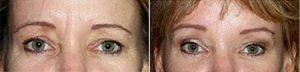 Female patient before and after blepharoplasty, image 04