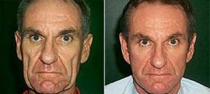 Facelift before & afters, adult male patient, front view