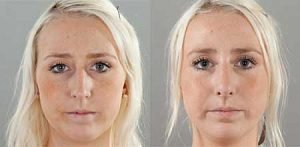 A nose job patient before and after surgery, image 17