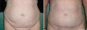 Abdominoplasty surgery, front view, patient before and after surgery