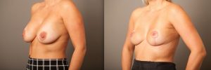 Patient before and after En Bloc breast implant removal at Gold Coast Plastic Surgery