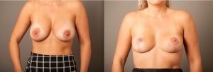 Image 05, En Bloc breast implant removal explant, Gold Coast Plastic Surgery