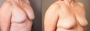 Patient before & after breast implant removal surgery with Dr Doyle, image 06
