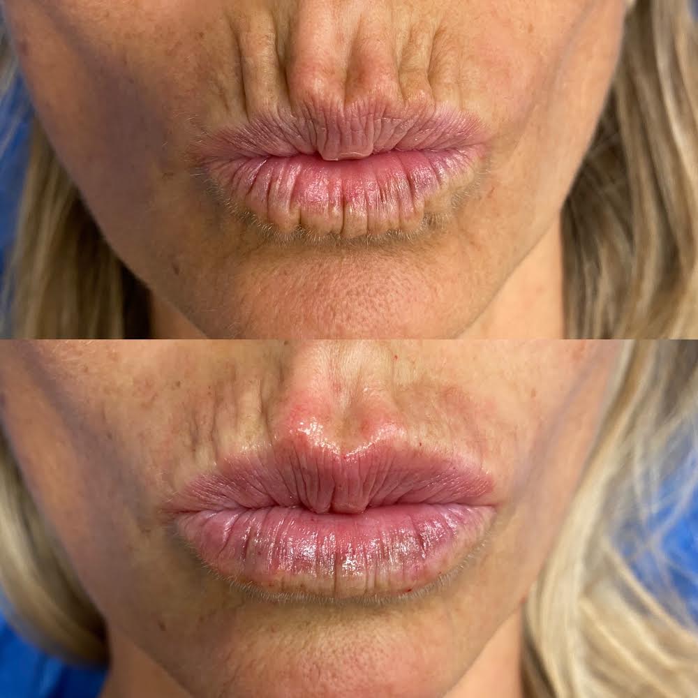anti wrinkle injections around the mouth