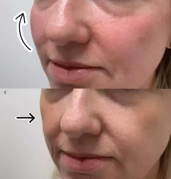 cheek filler restore lost volume