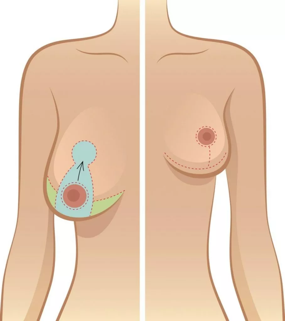 Procedure Breast Reduction - Australia Cosmetic Clinics
