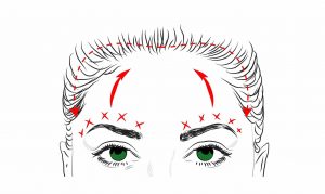 eyebrow lift procedure forehead lift plastic surgery queensland