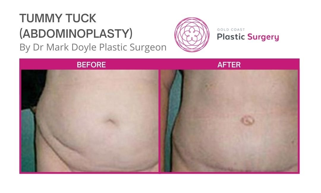 tummy tuck before and after pics