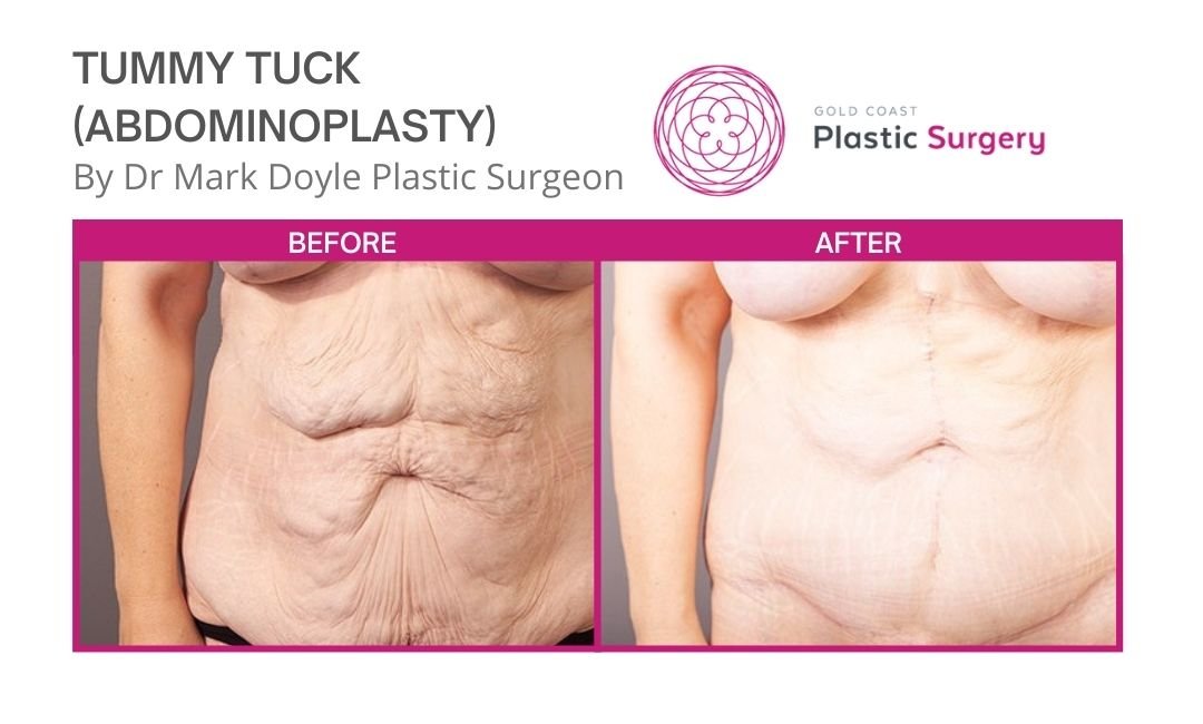 tummy tuck photos before and after australia