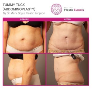 before and after pictures tummy tuck brisbane