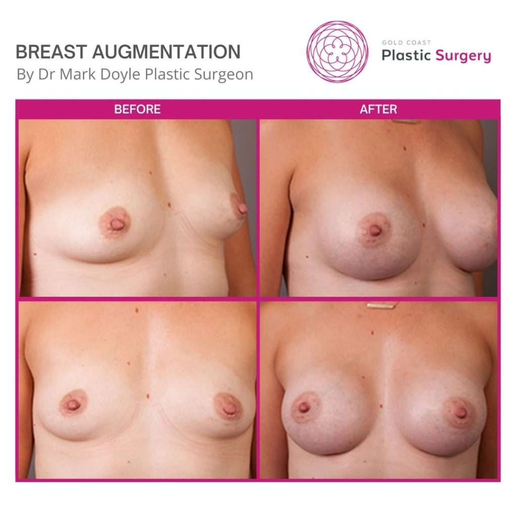 breast augmentation plastic surgery before and after images